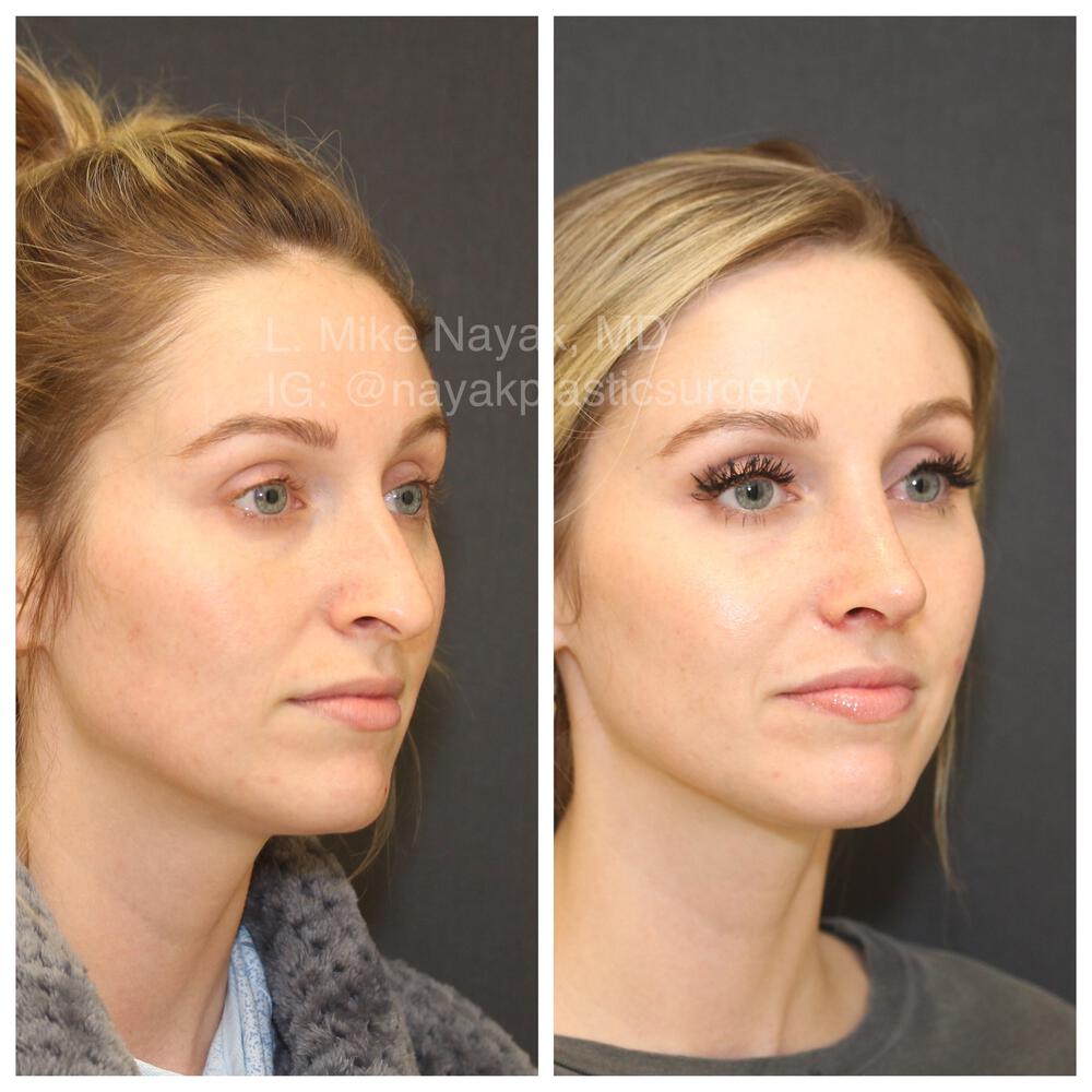 Rhinoplasty Before & After Image