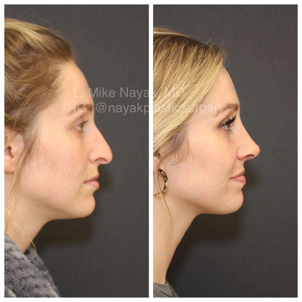 Rhinoplasty Before & After Image