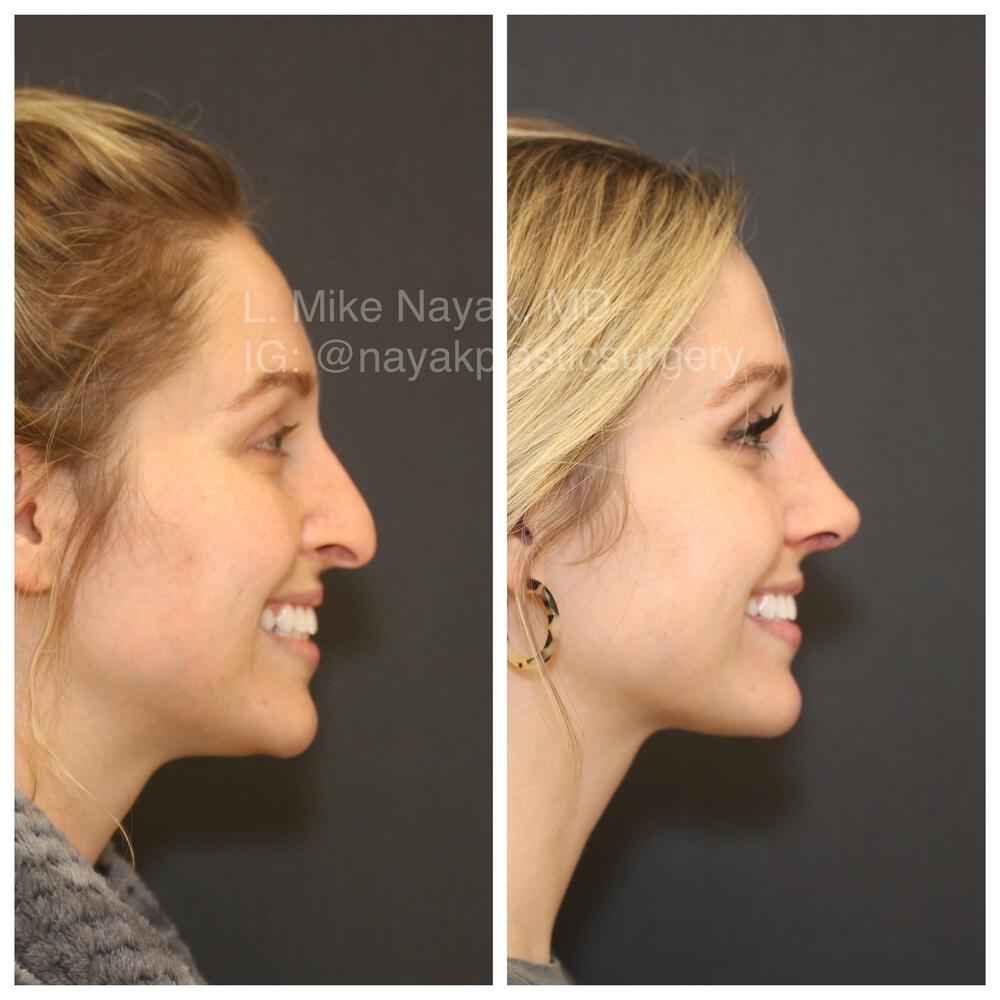 Rhinoplasty Before & After Image