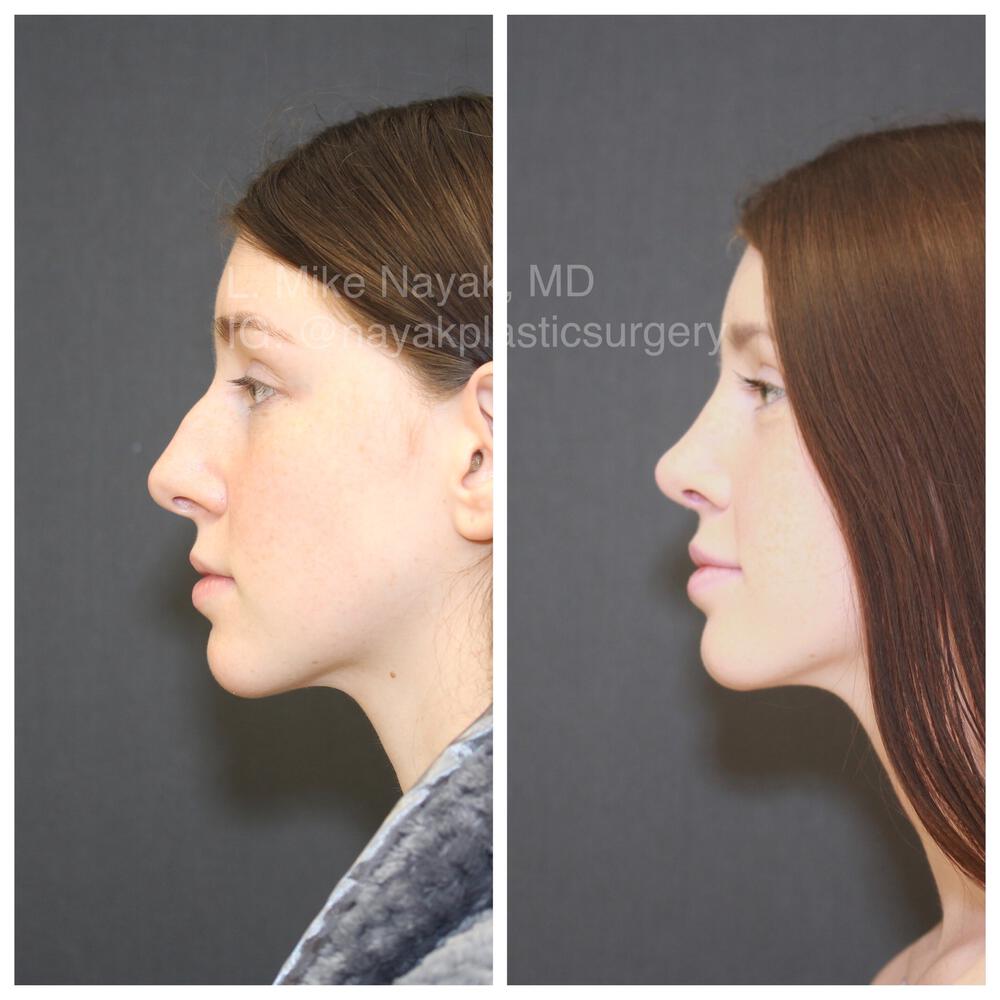 Rhinoplasty Before & After Image