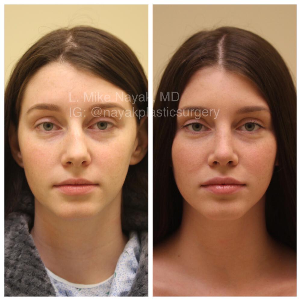 Rhinoplasty Before & After Image