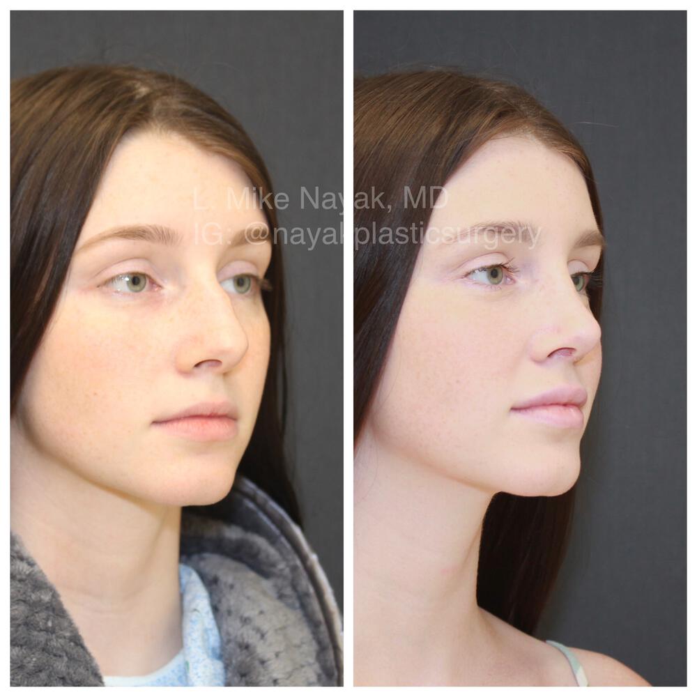 Rhinoplasty Before & After Image