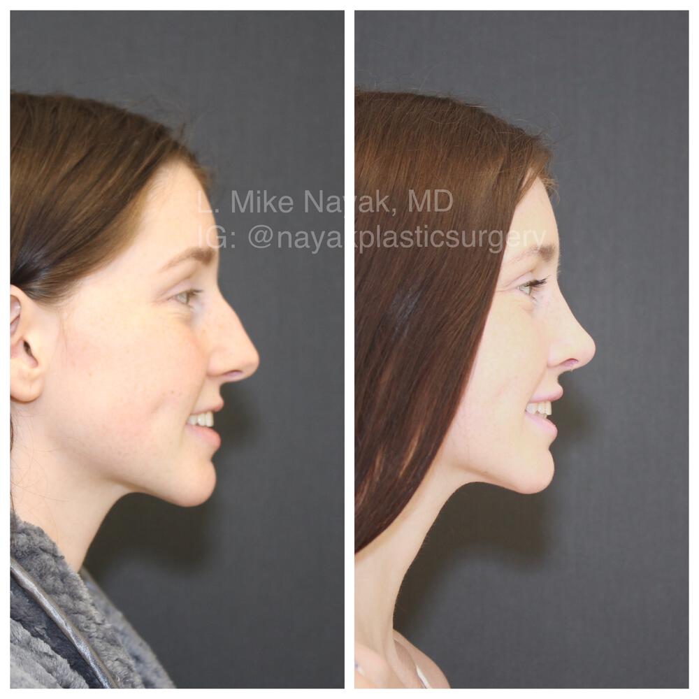 Rhinoplasty Before & After Image