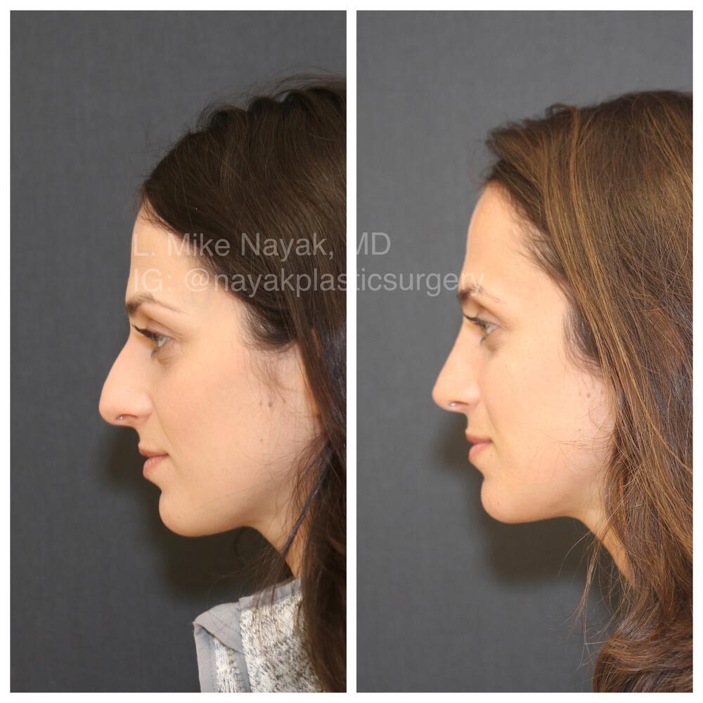 Rhinoplasty Before & After Image