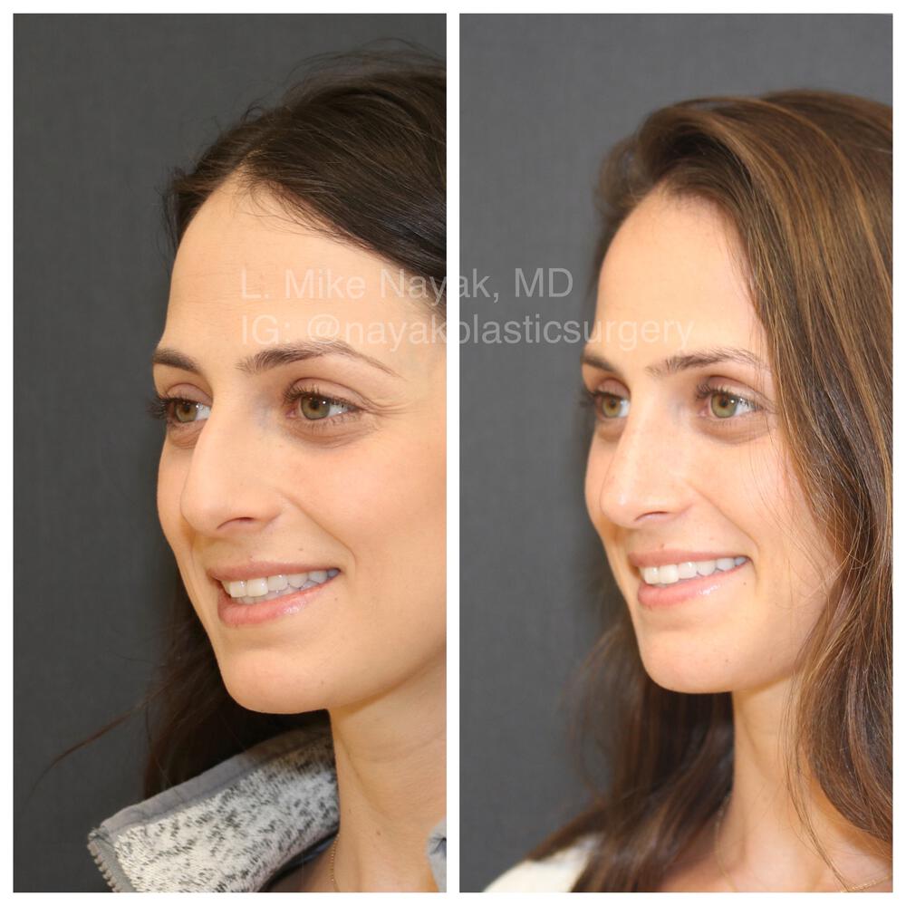 Rhinoplasty Before & After Image