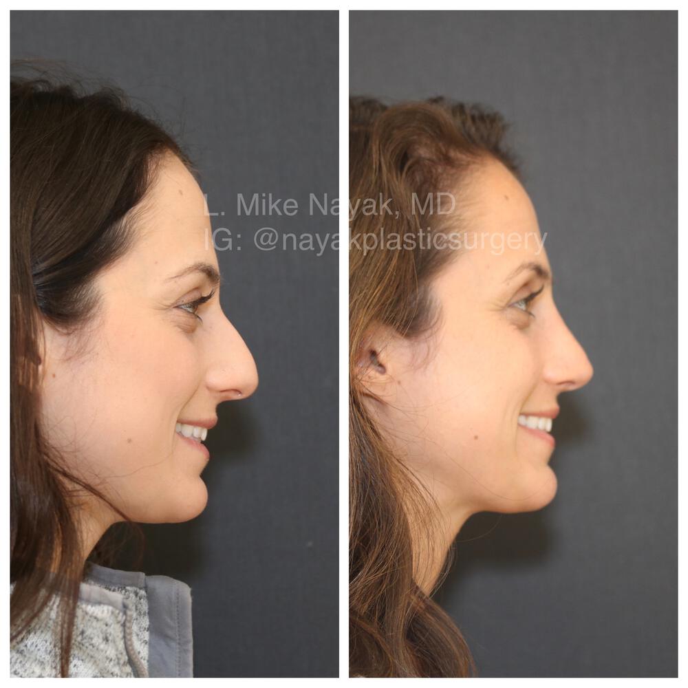 Rhinoplasty Before & After Image