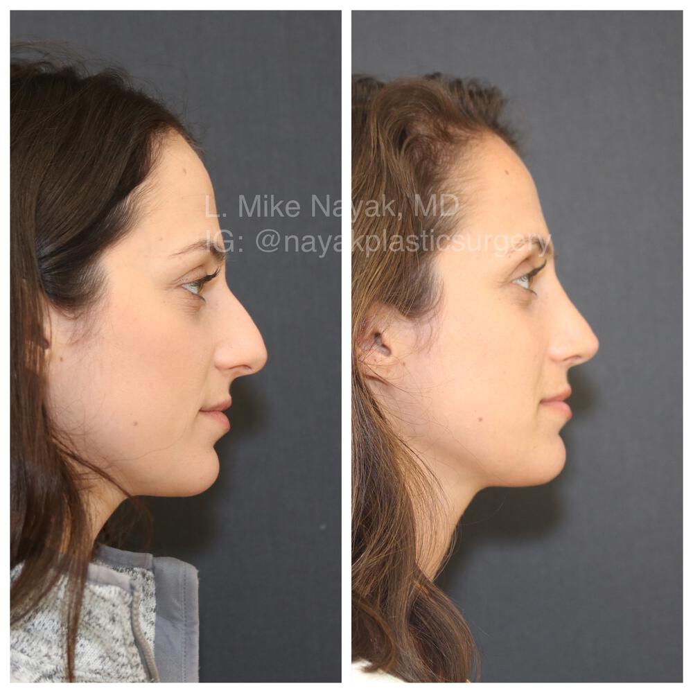 Rhinoplasty Before & After Image