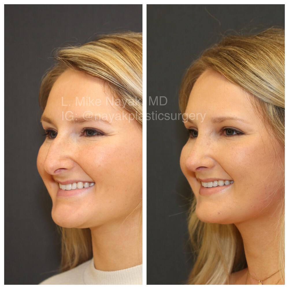 Rhinoplasty Before & After Image