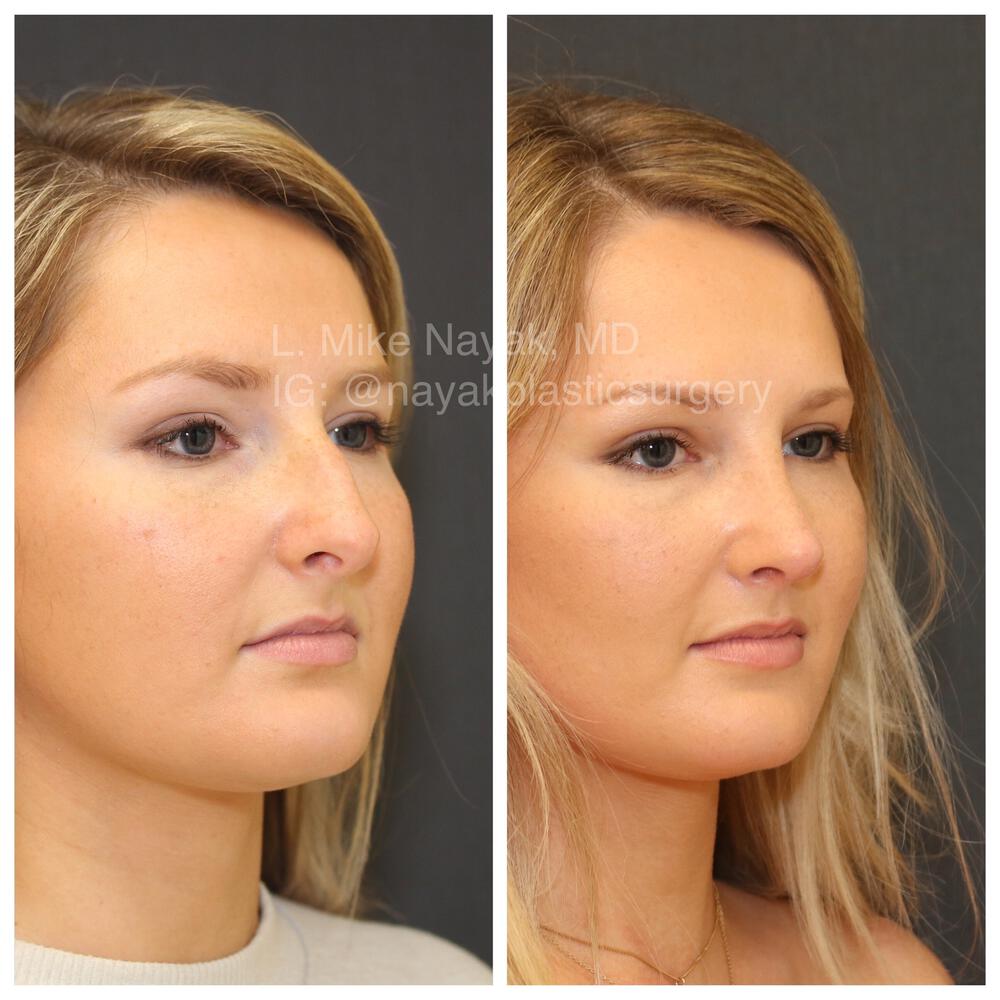 Rhinoplasty Before & After Image