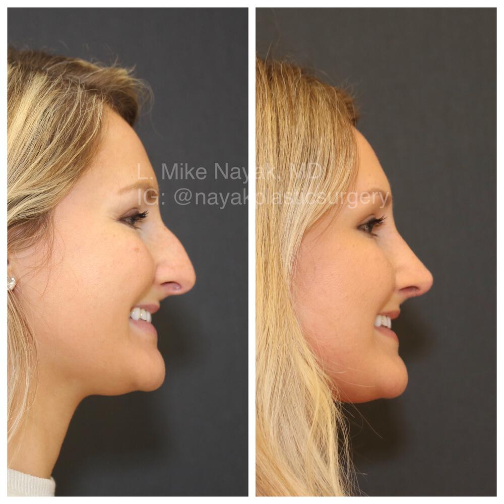 Rhinoplasty Before & After Image