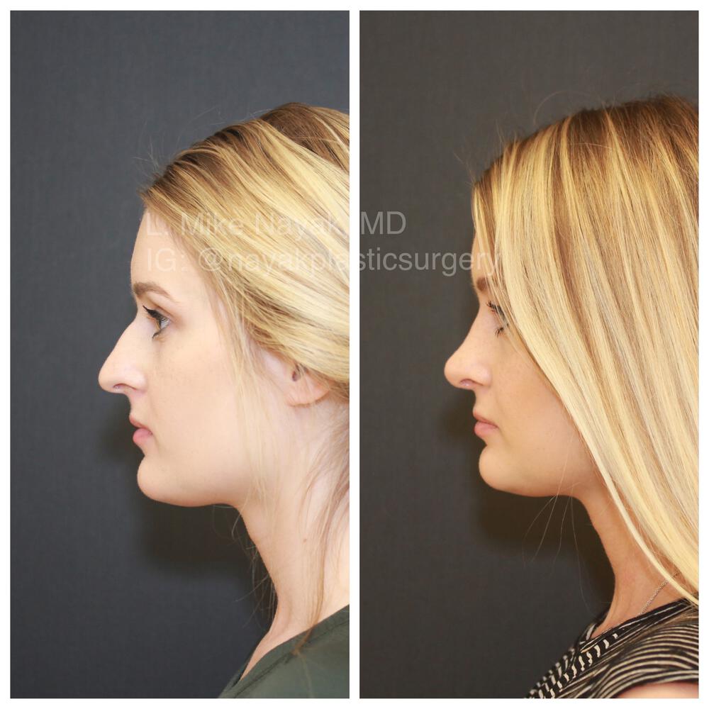 Rhinoplasty Before & After Image