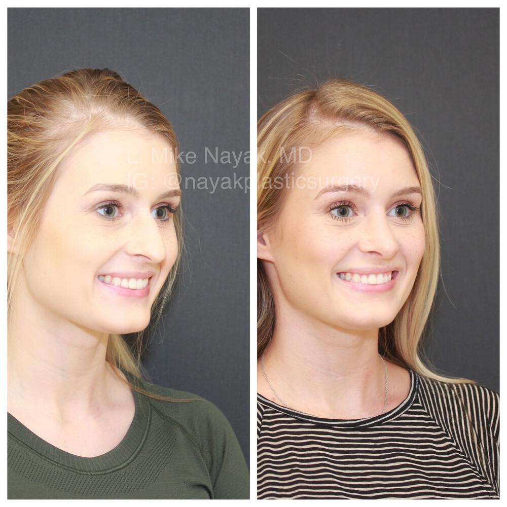 Rhinoplasty Before & After Image