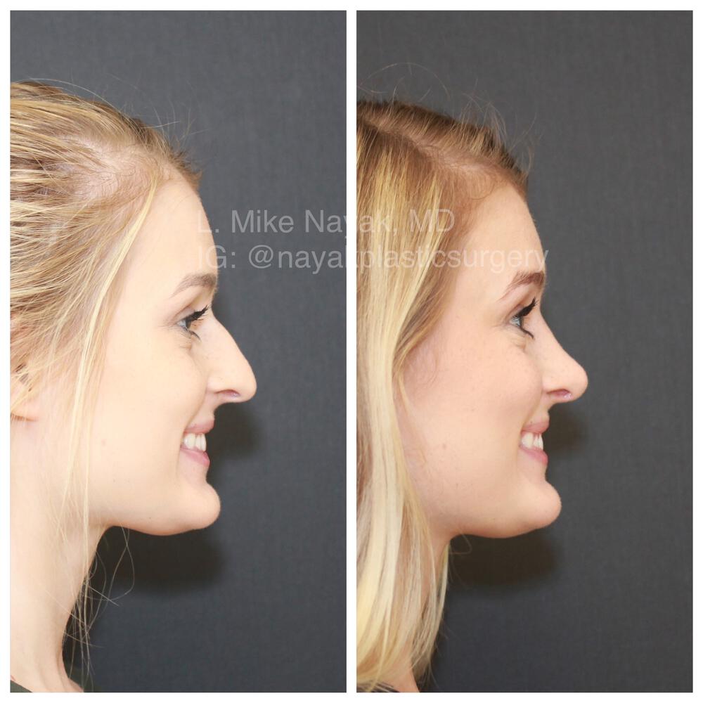 Rhinoplasty Before & After Image