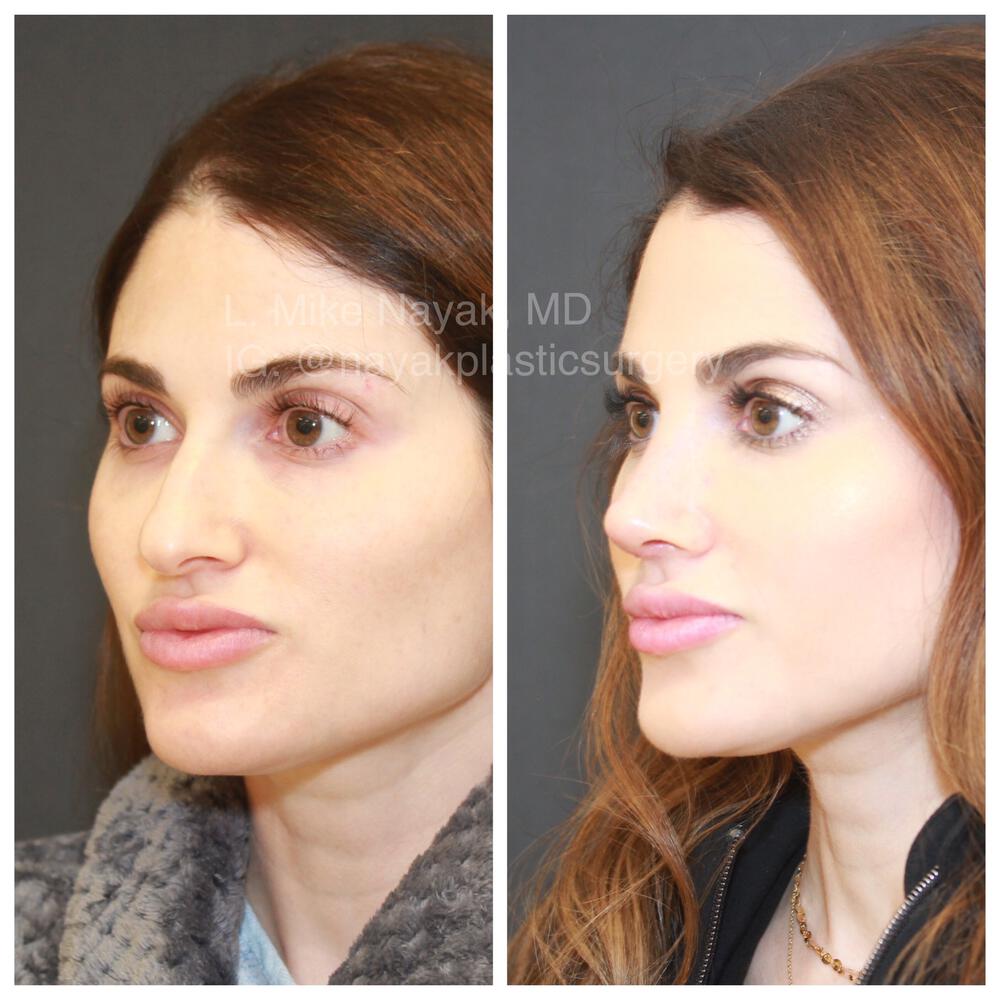 Rhinoplasty Before & After Image