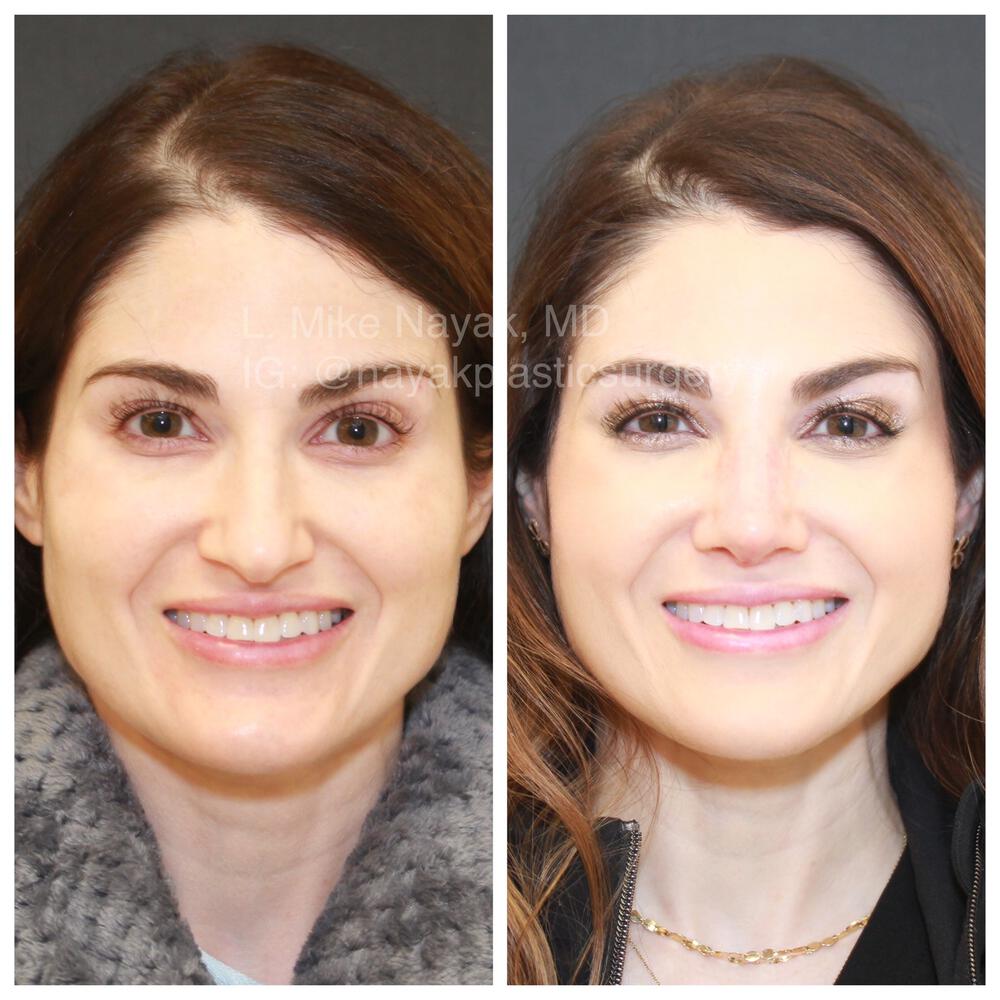 Rhinoplasty Before & After Image