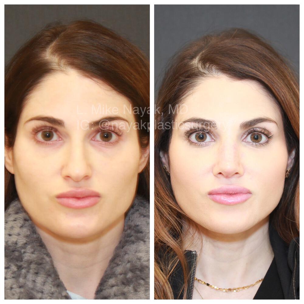 Rhinoplasty Before & After Image