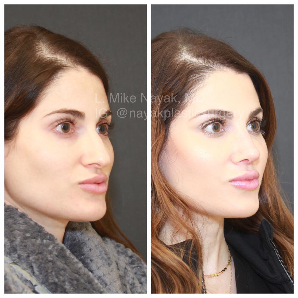 Rhinoplasty Before & After Image