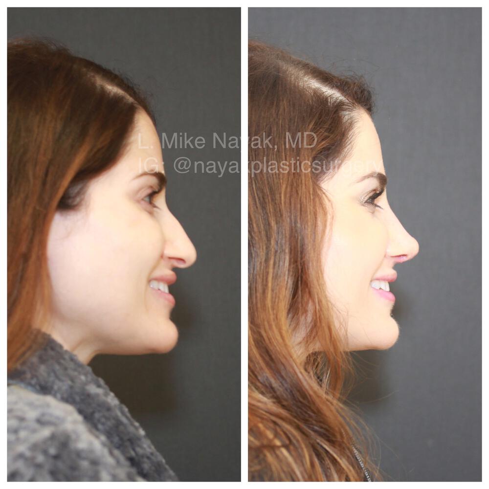 Rhinoplasty Before & After Image