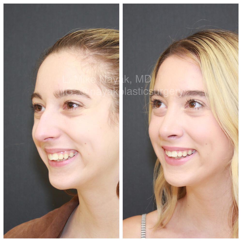 Rhinoplasty Before & After Image