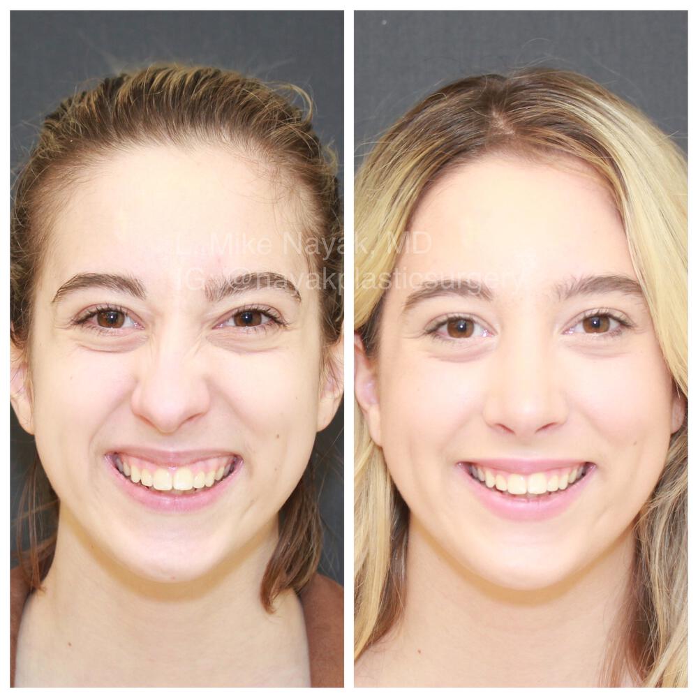 Rhinoplasty Before & After Image