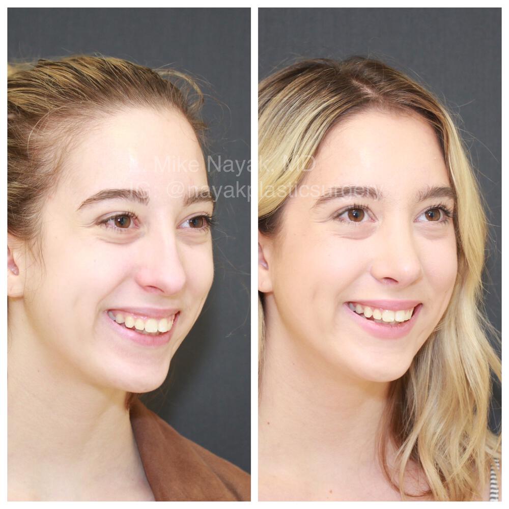 Rhinoplasty Before & After Image