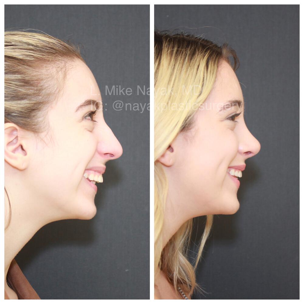 Rhinoplasty Before & After Image