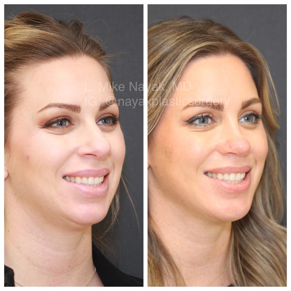 Rhinoplasty Before & After Image