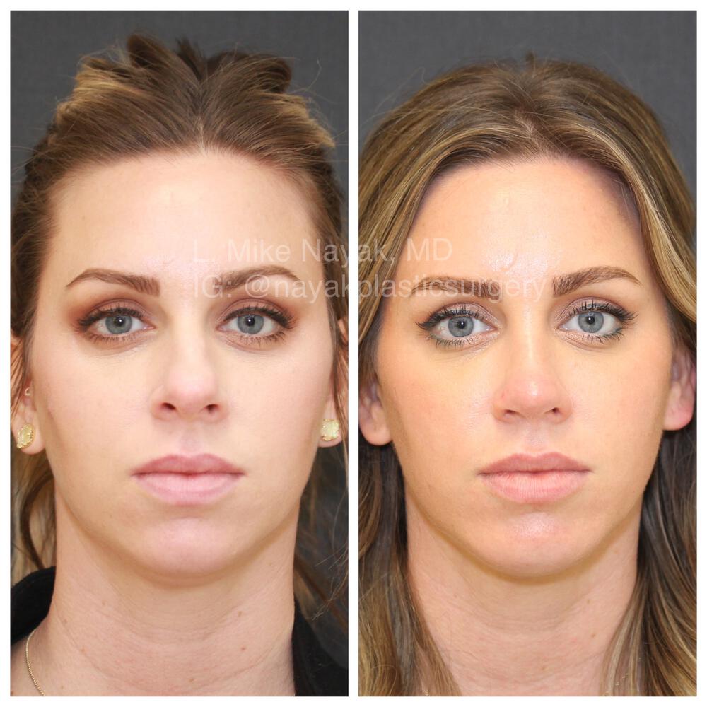 Rhinoplasty Before & After Image