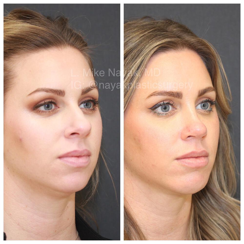 Rhinoplasty Before & After Image