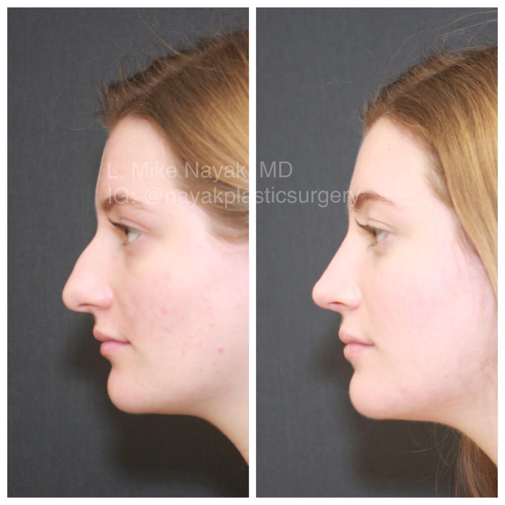 Rhinoplasty Before & After Image