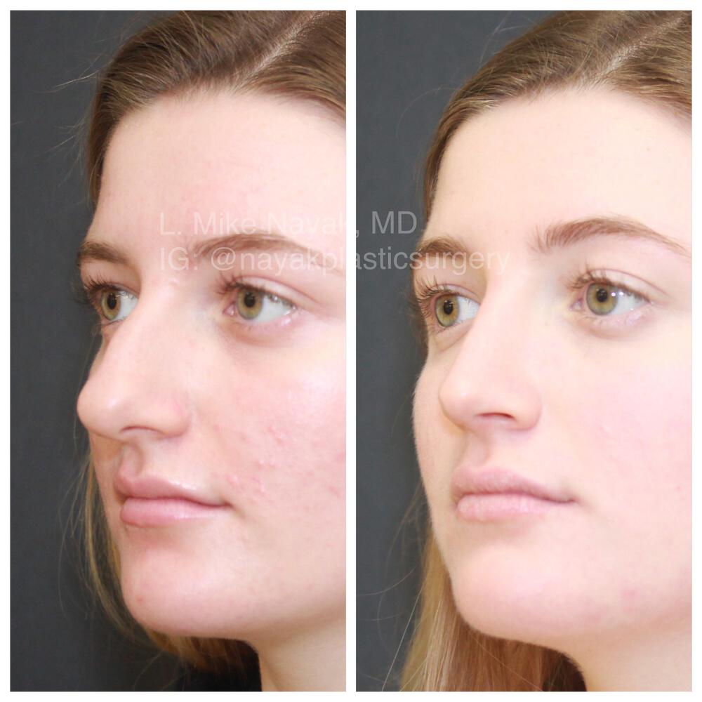 Rhinoplasty Before & After Image