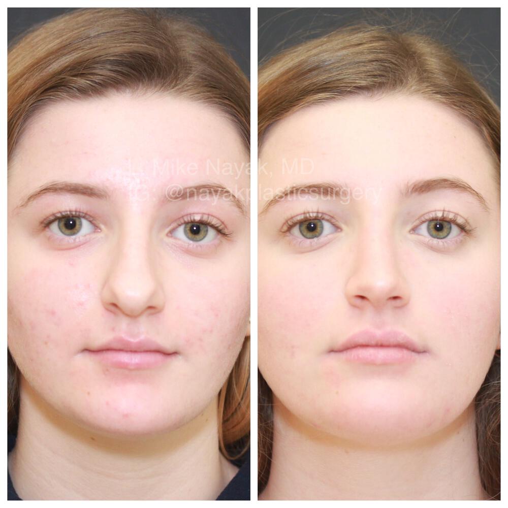 Rhinoplasty Before & After Image