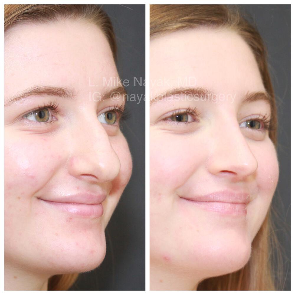 Rhinoplasty Before & After Image