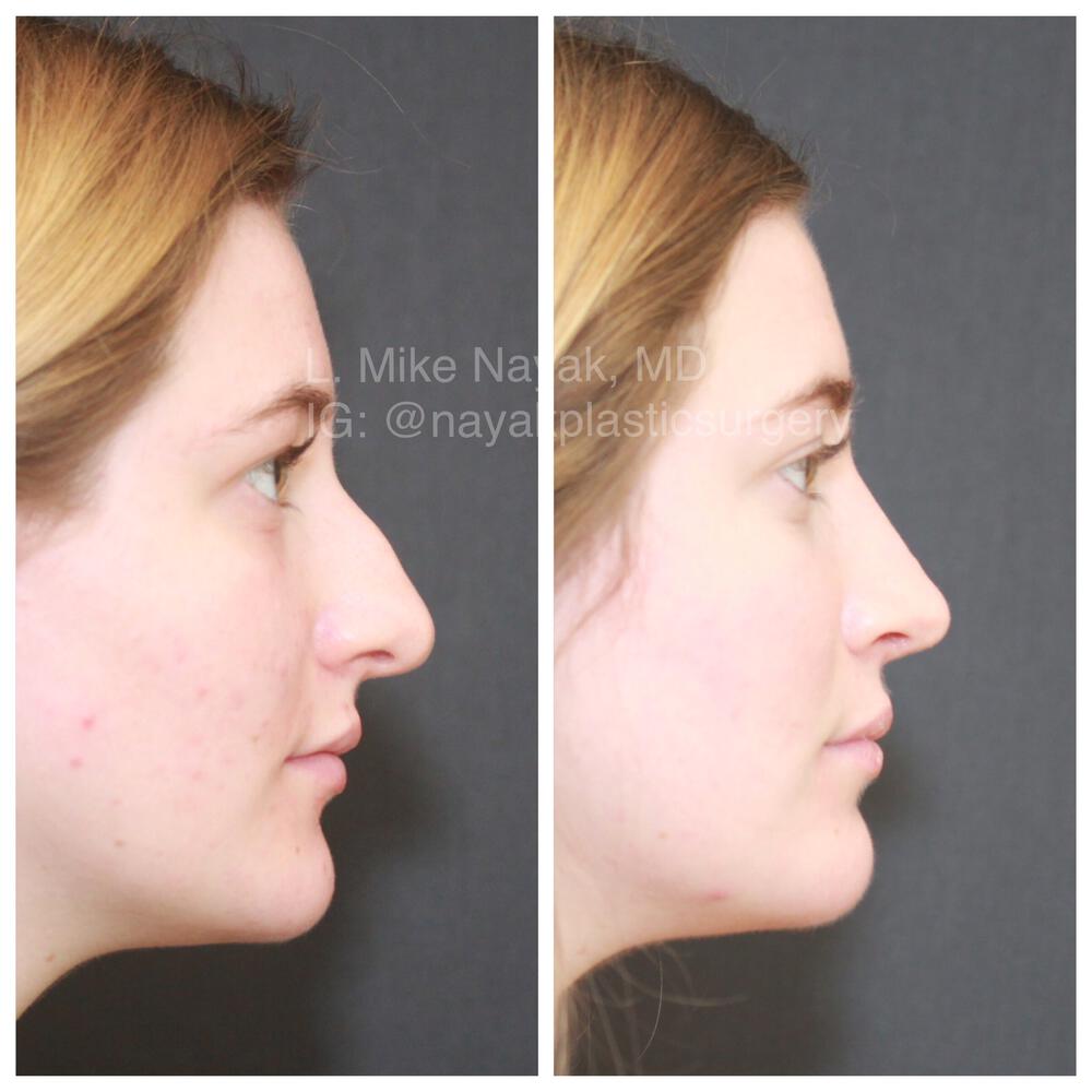 Rhinoplasty Before & After Image