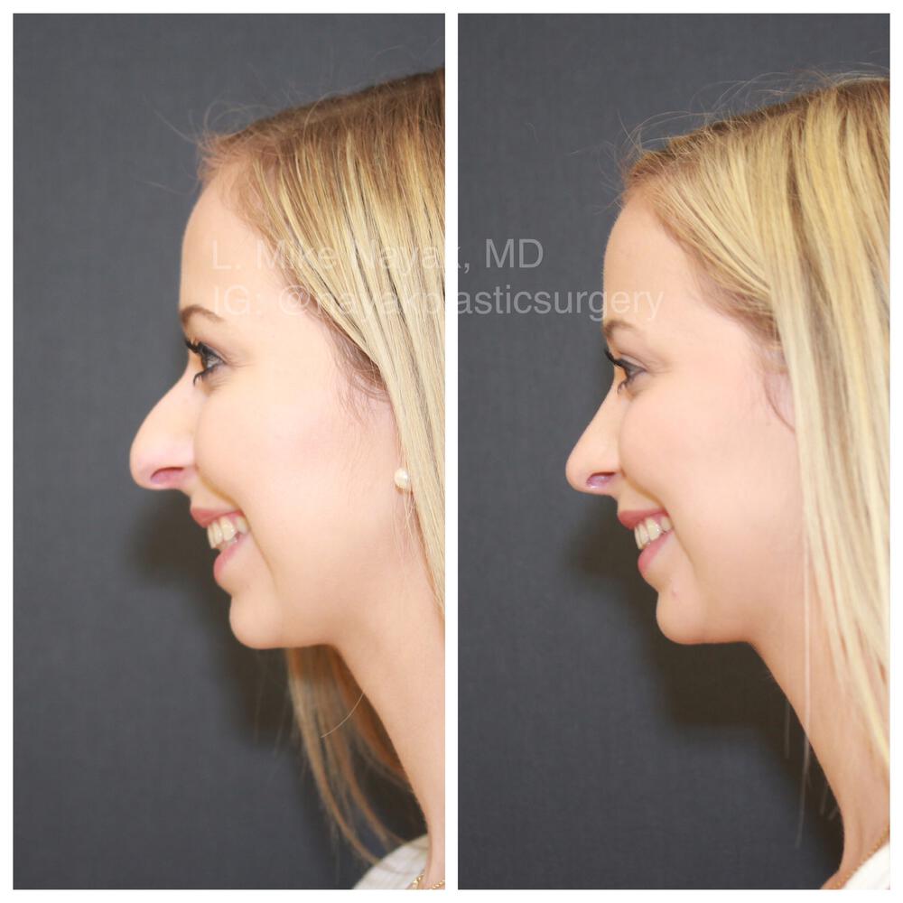 Rhinoplasty Before & After Image