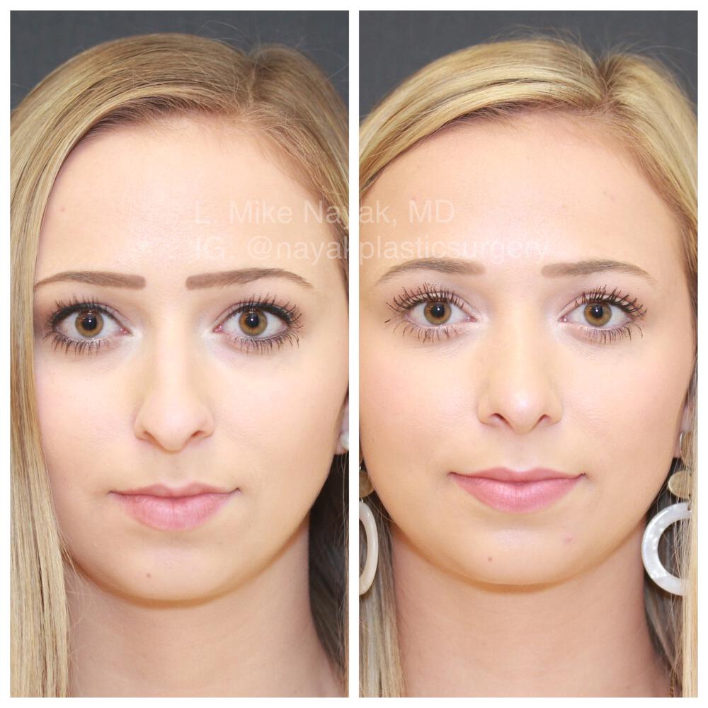 Rhinoplasty Before & After Image