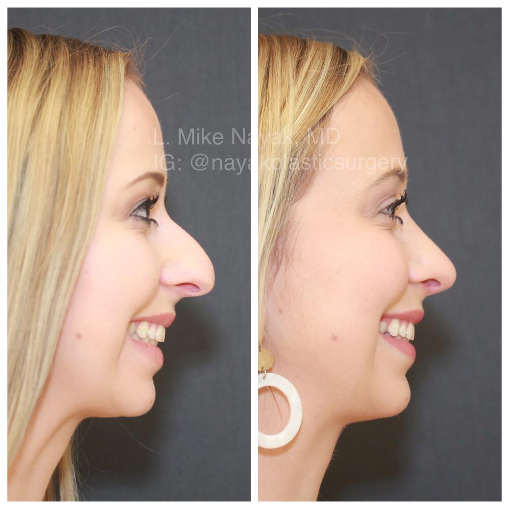 Rhinoplasty Before & After Image