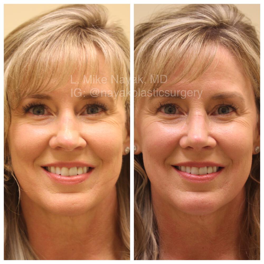 Rhinoplasty Before & After Image