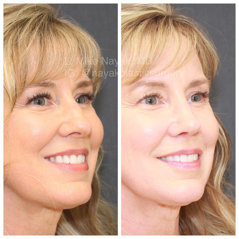 Rhinoplasty Before & After Image