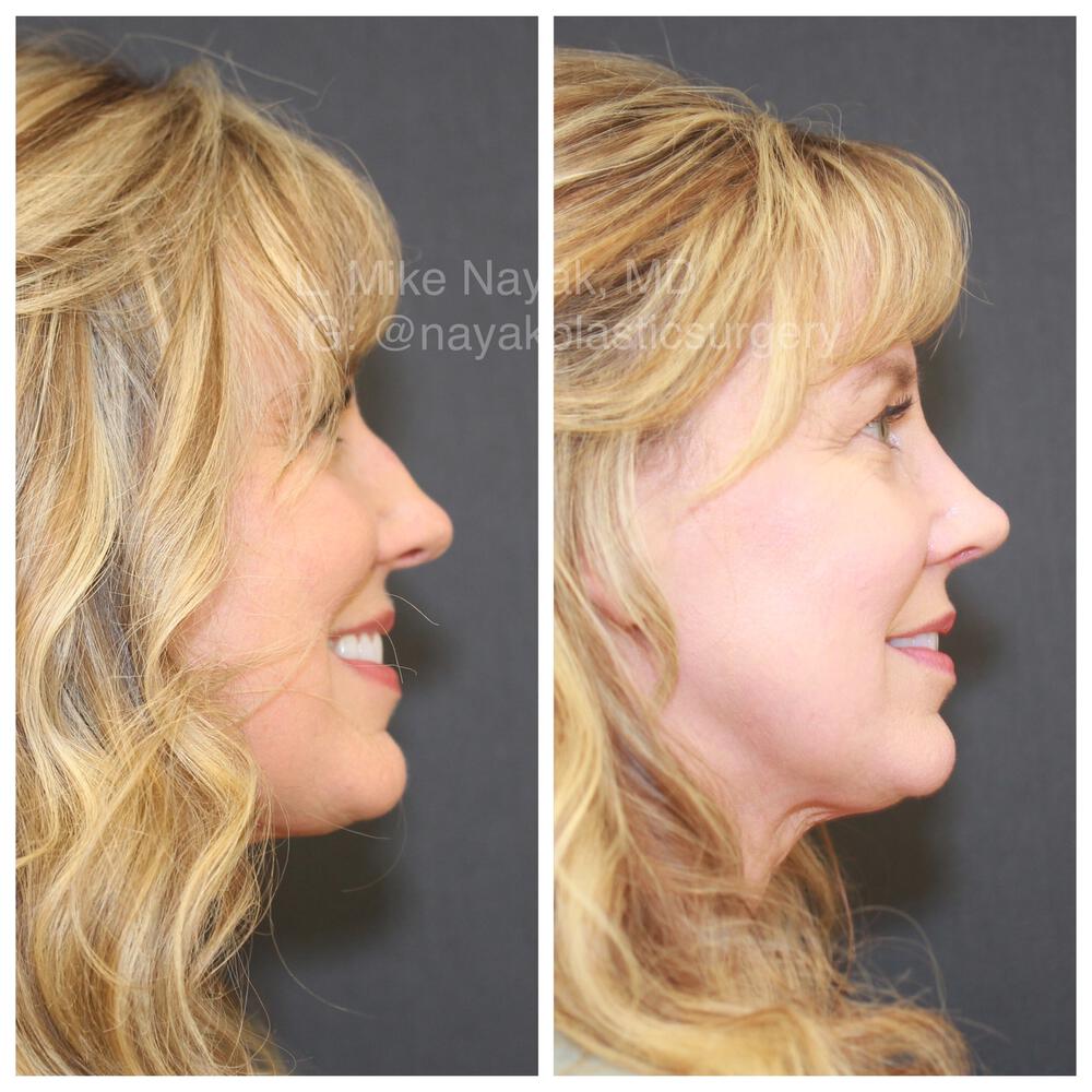 Rhinoplasty Before & After Image