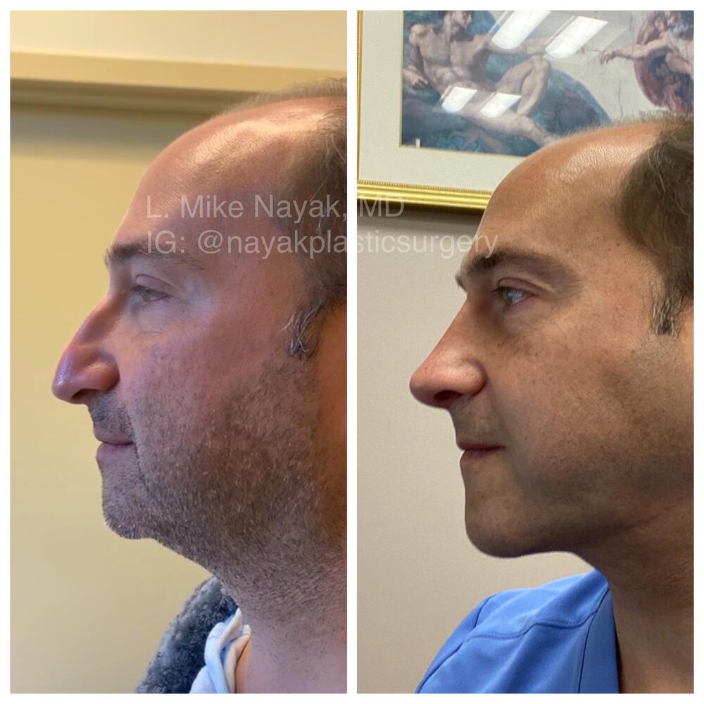 Rhinoplasty Before & After Image