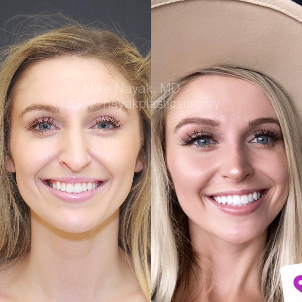 Rhinoplasty Before & After Image