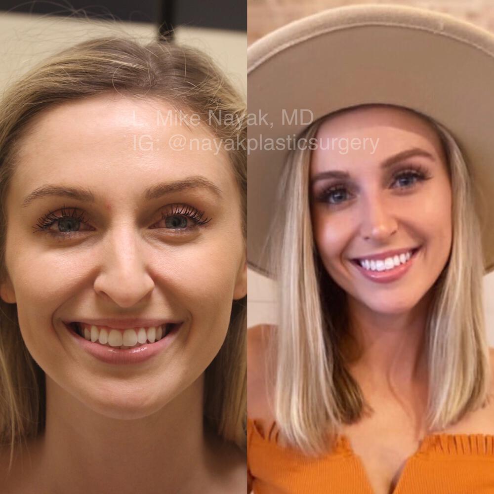 Rhinoplasty Before & After Image