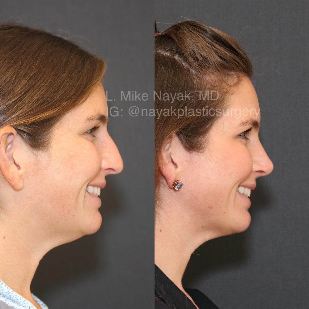 Rhinoplasty Before & After Image