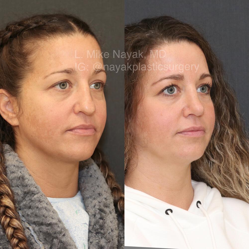 Rhinoplasty Before & After Image