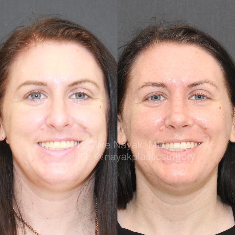 Rhinoplasty Before & After Image