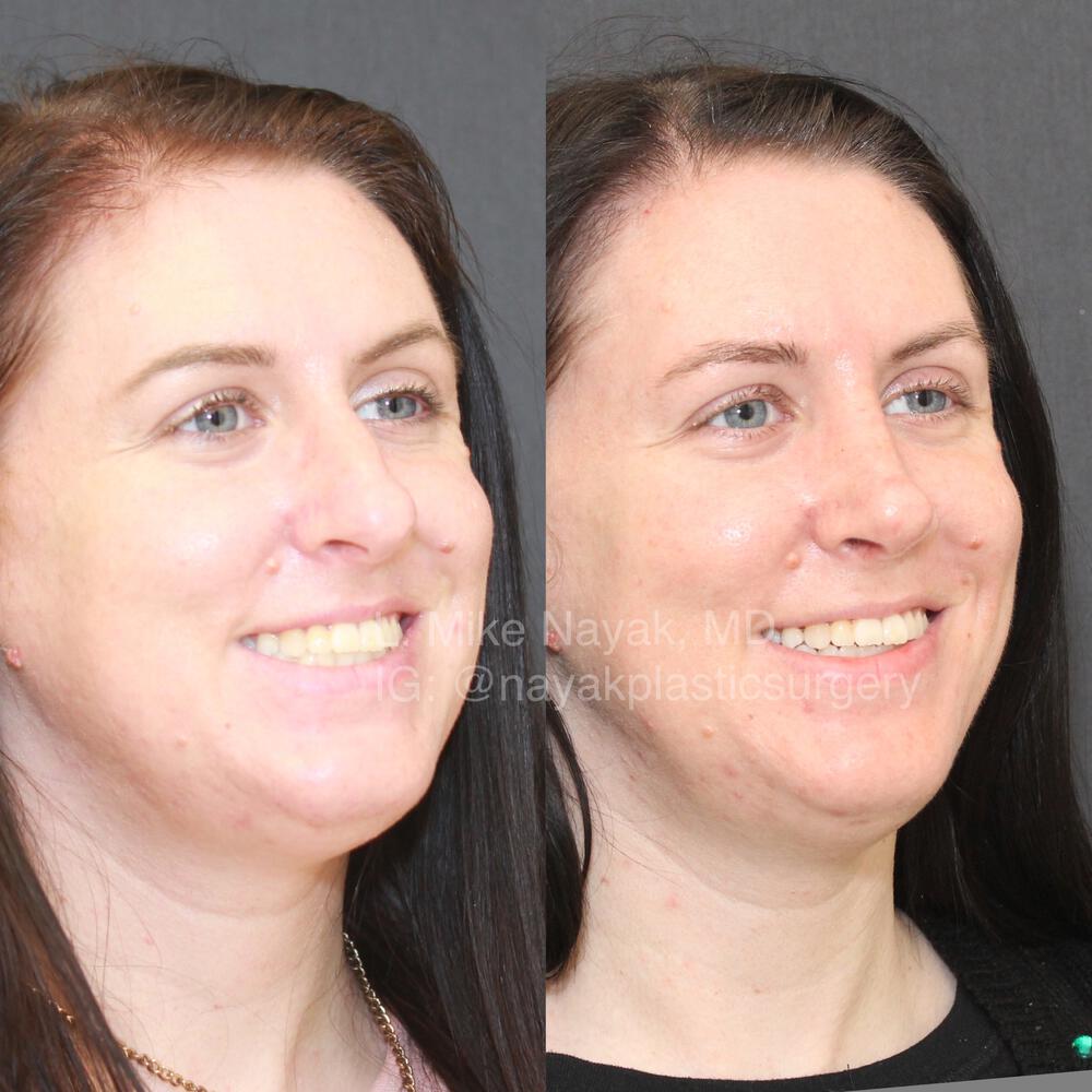 Rhinoplasty Before & After Image