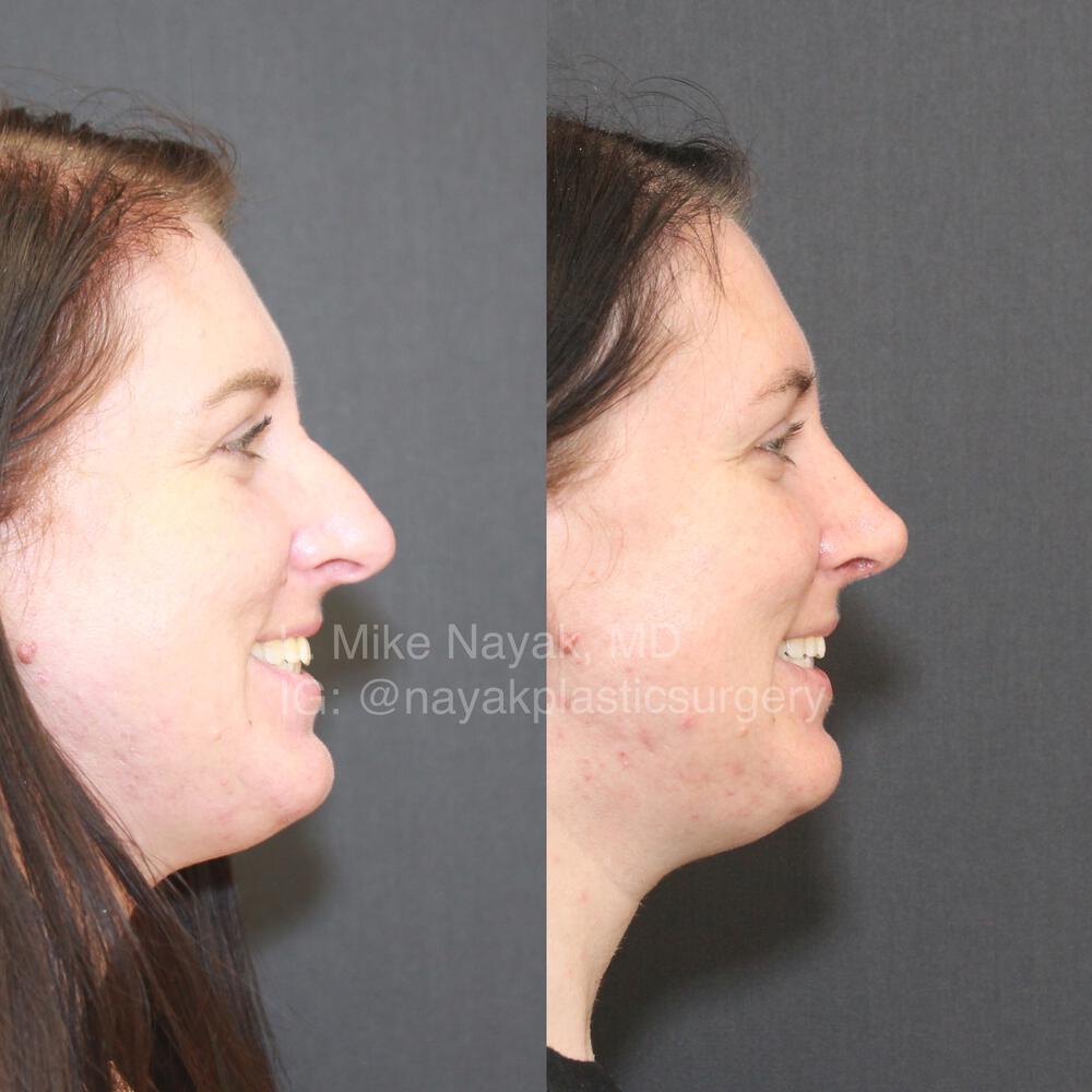 Rhinoplasty Before & After Image