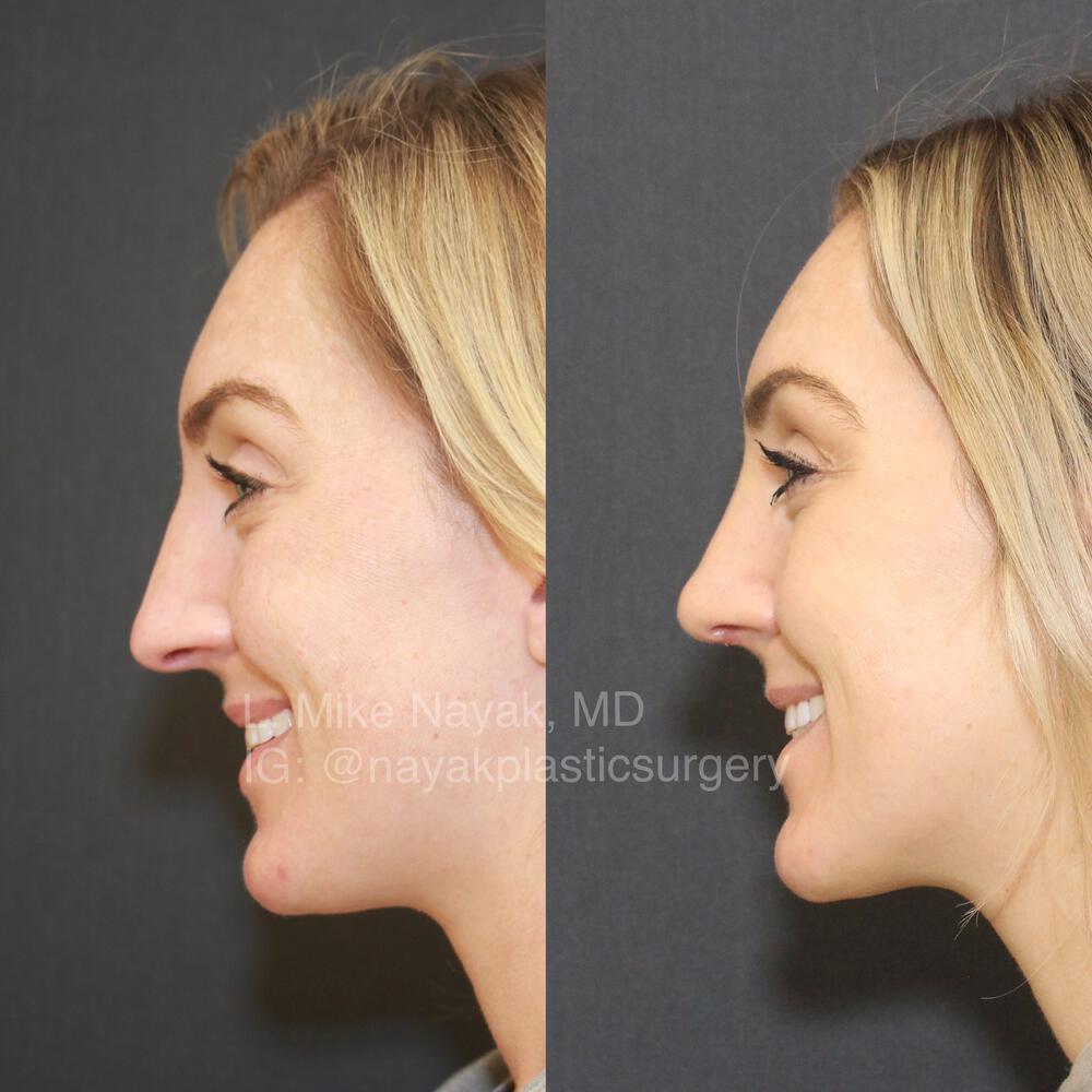 Rhinoplasty Before & After Image