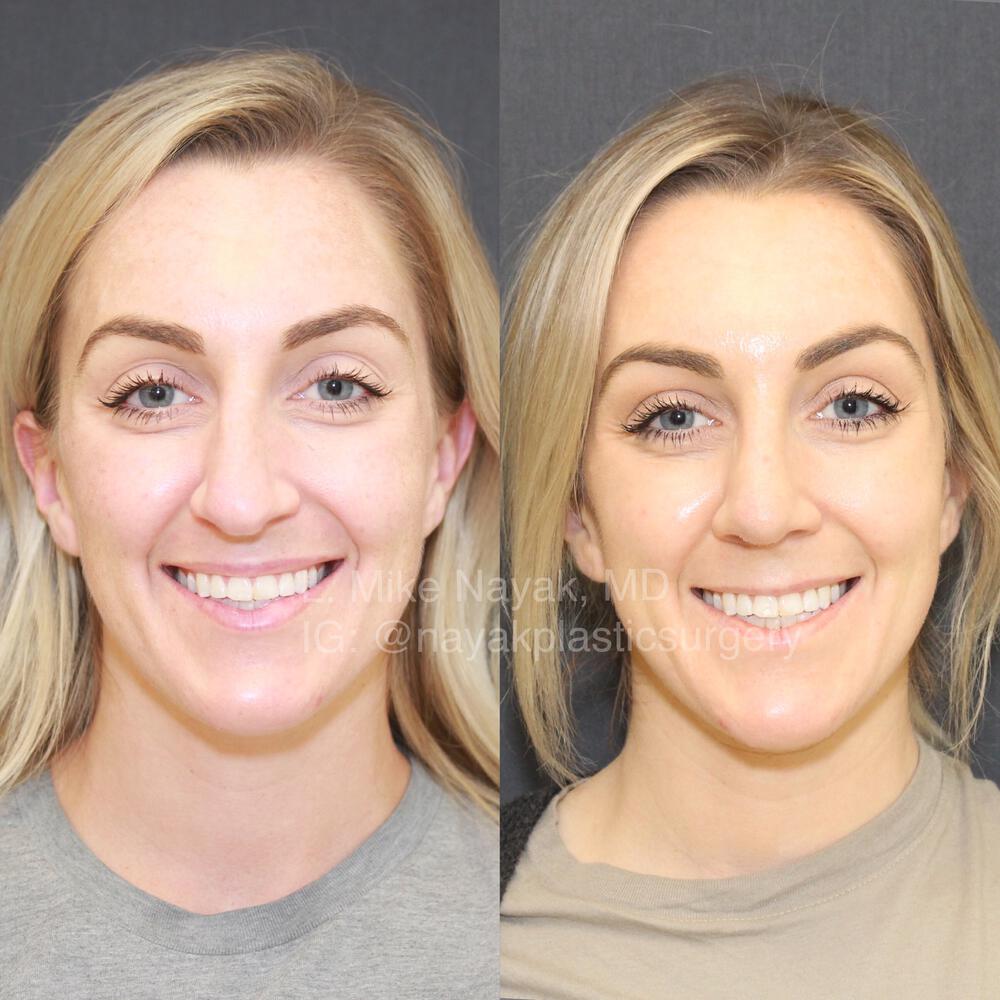 Rhinoplasty Before & After Image